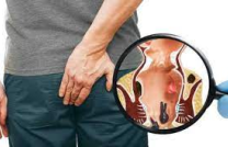 PILES SPECIALIST DOCTOR IN CONGO  +27789982777 mediacongo